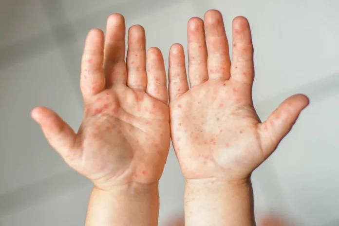 Measles morbilivirus